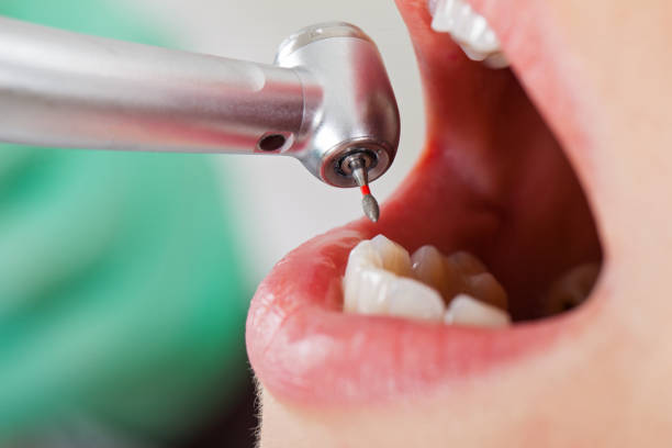 Best Emergency Tooth Extraction in Mascotte, FL